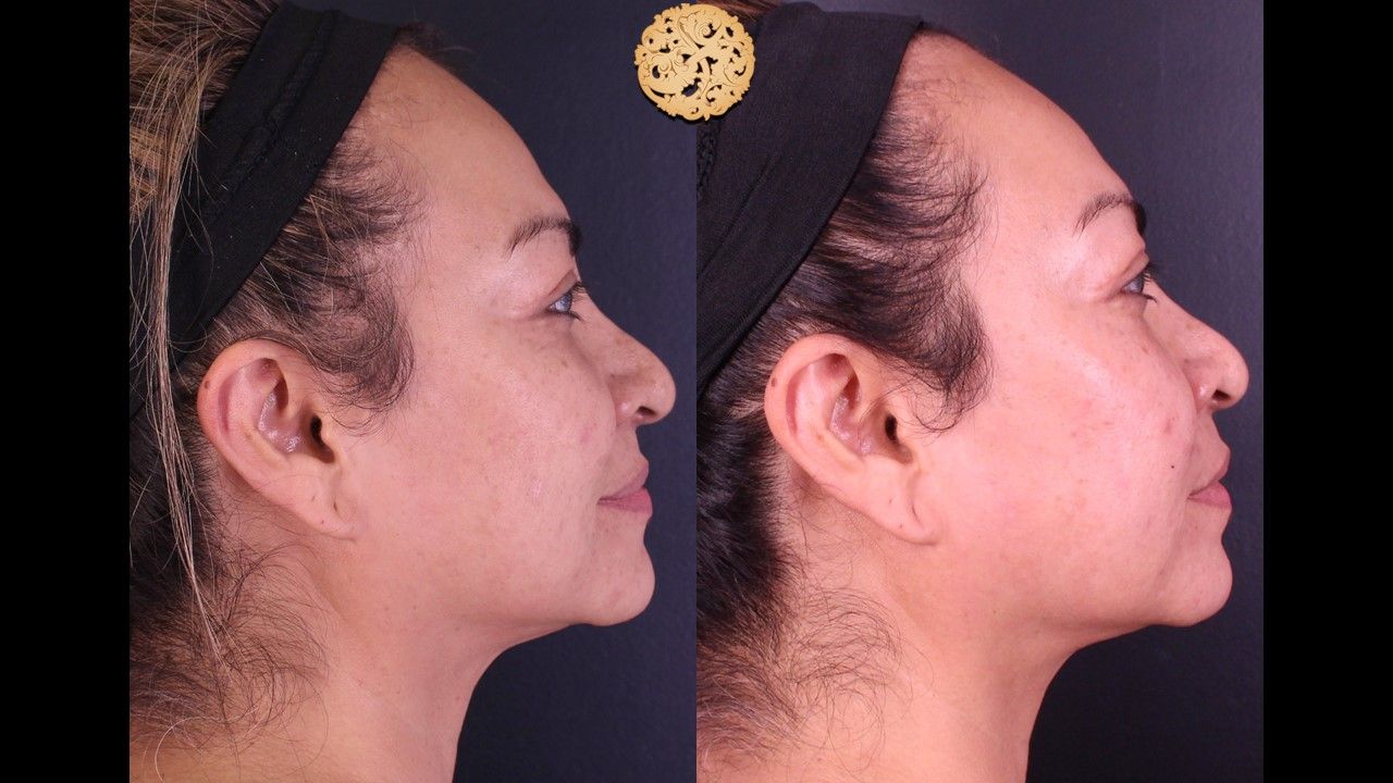 Chemical Peel Before & After