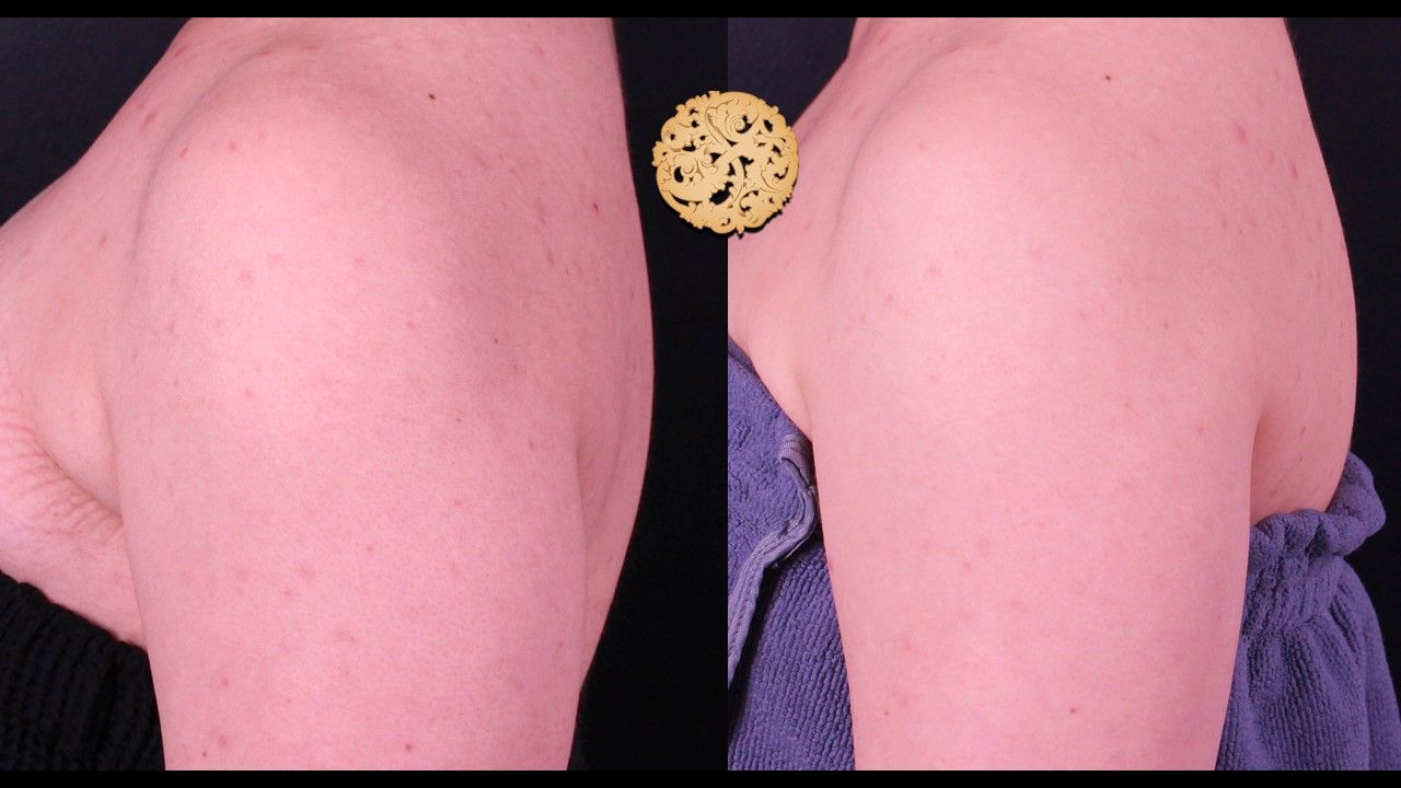 Chemical Peel Before & After