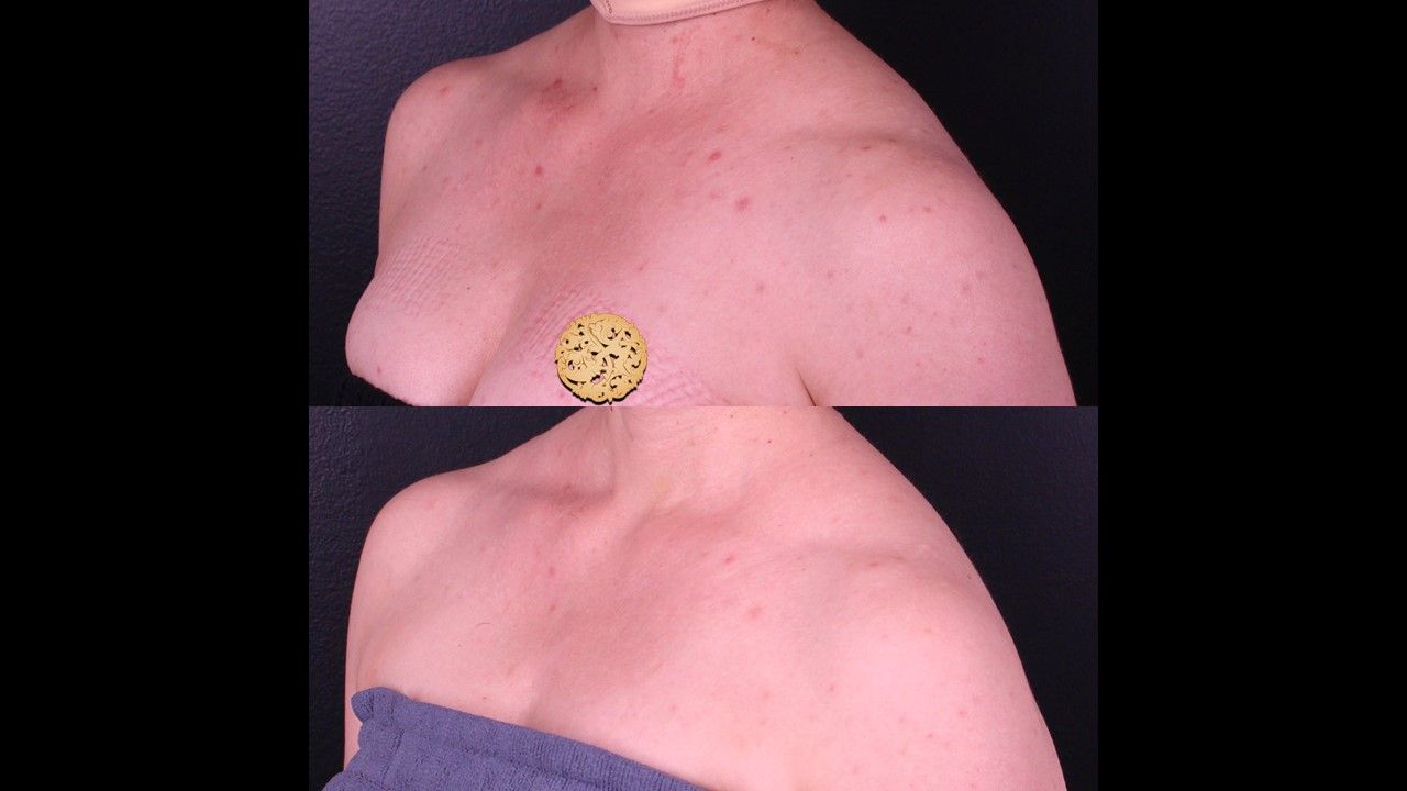 Chemical Peel Before & After