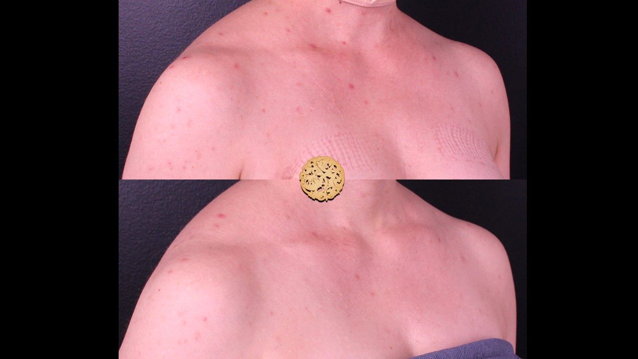 Chemical Peel Before & After