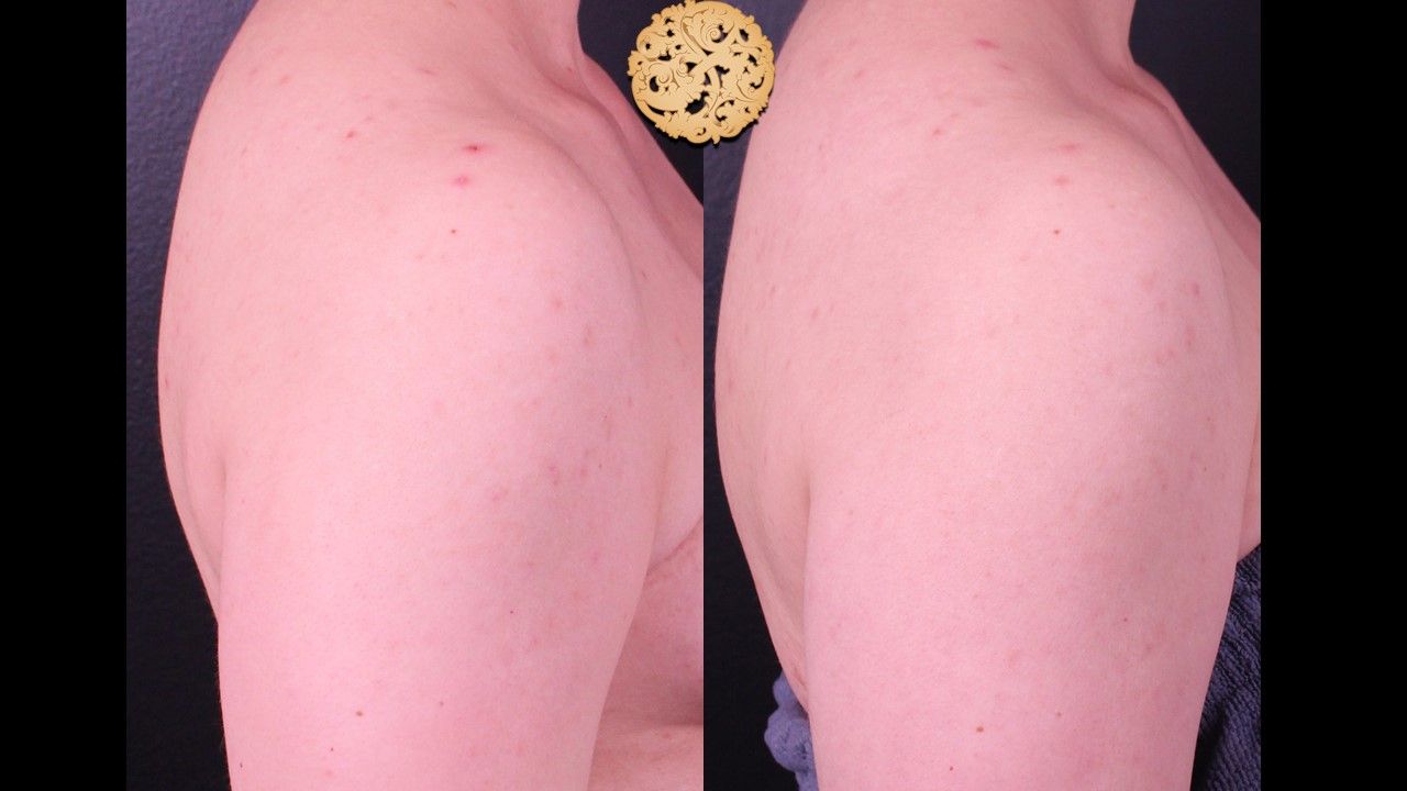 Chemical Peel Before & After