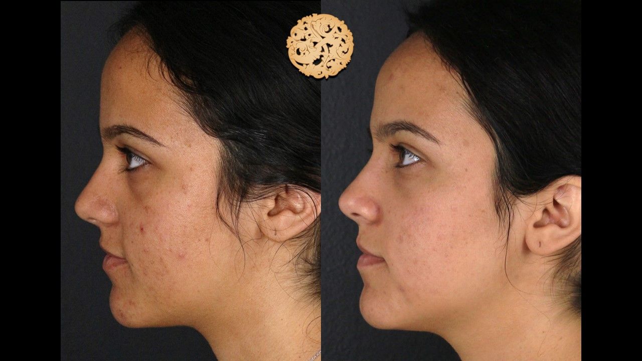 Chemical Peel Before & After