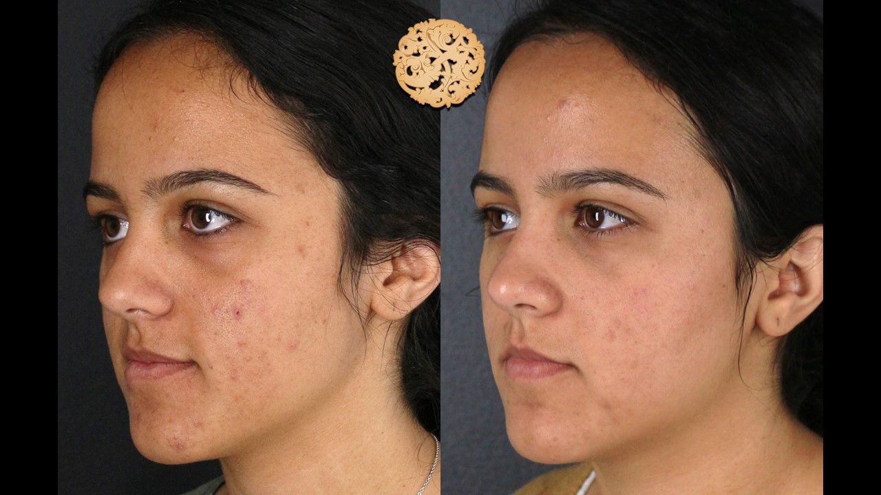 Chemical Peel Before & After
