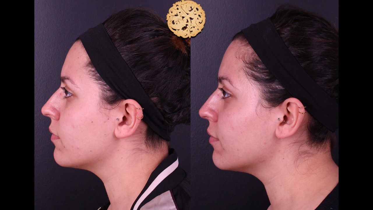 Chemical Peel Before & After