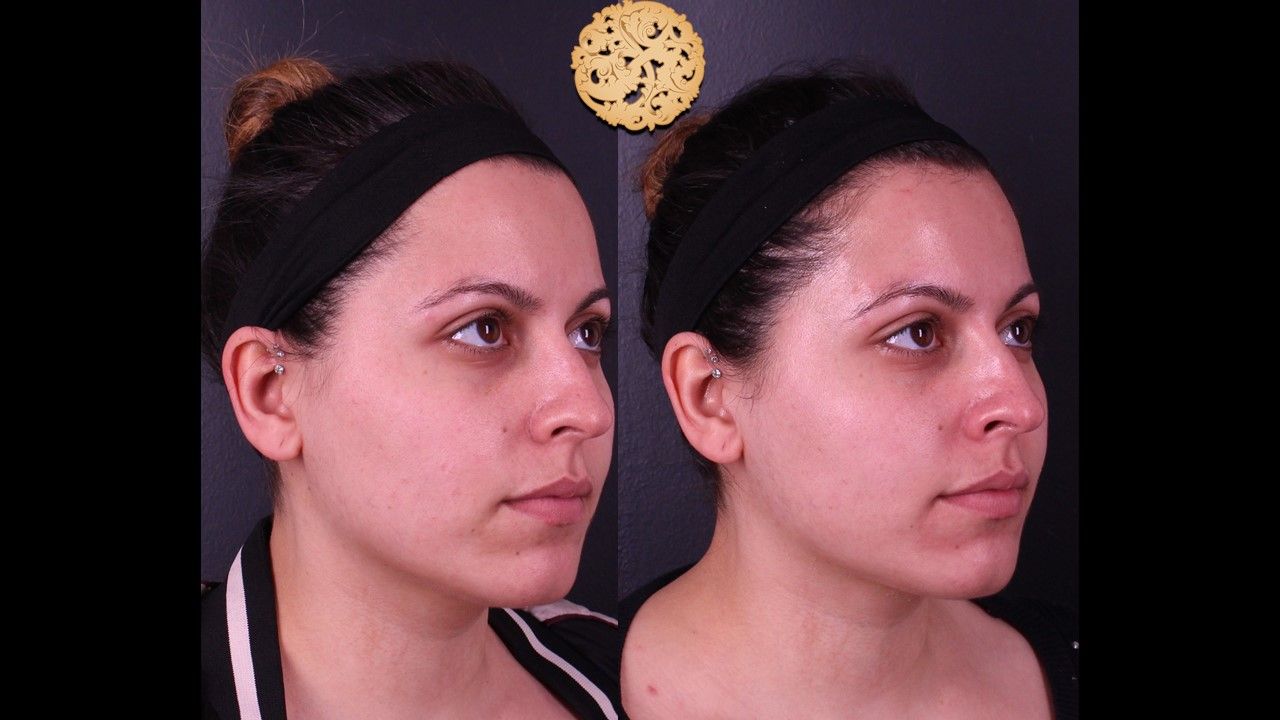 Chemical Peel Before & After