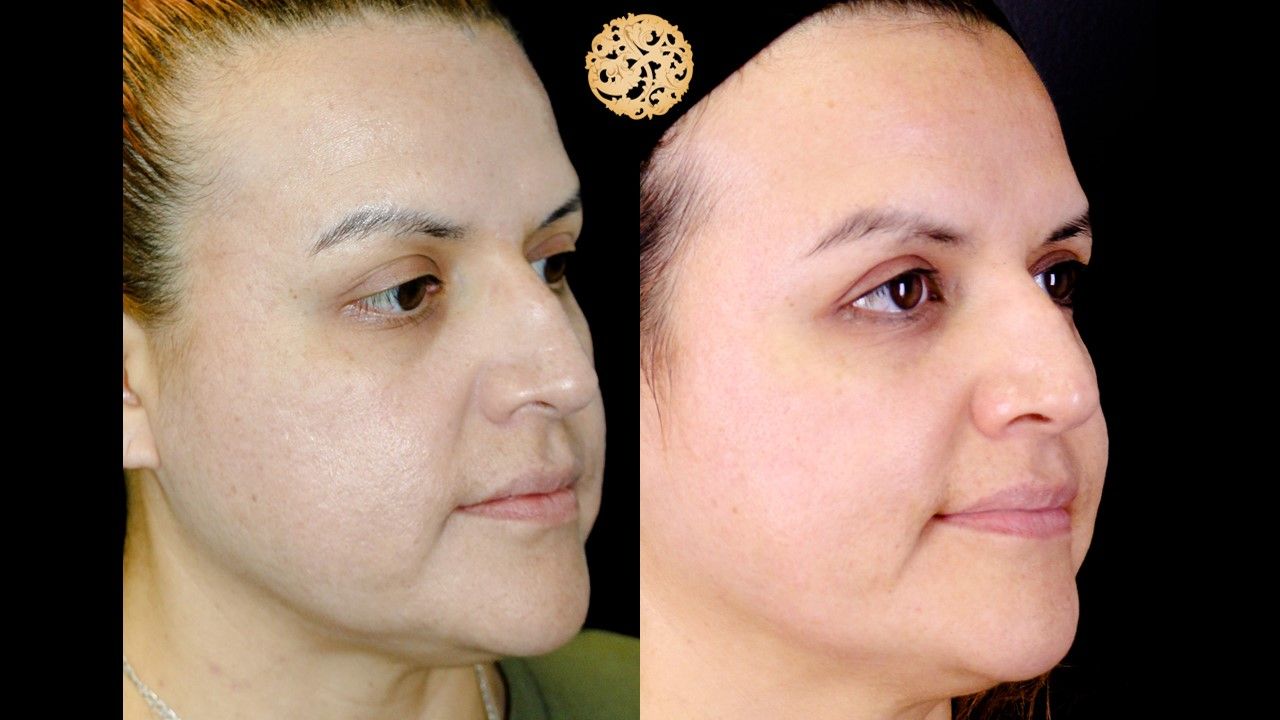 Chemical Peel Before & After