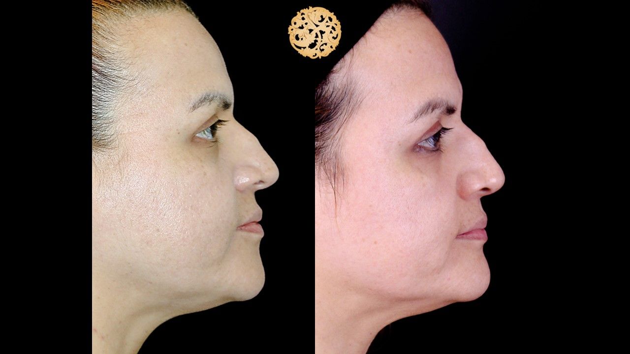 Chemical Peel Before & After