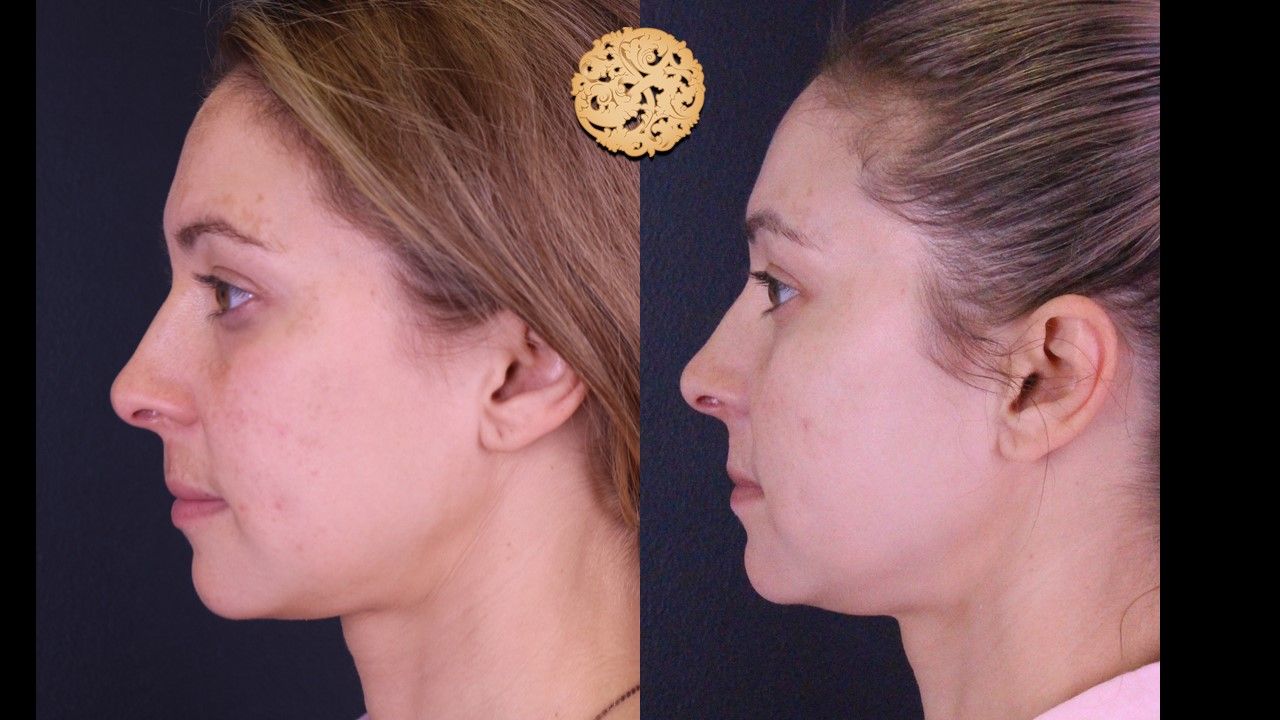 Chemical Peel Before & After