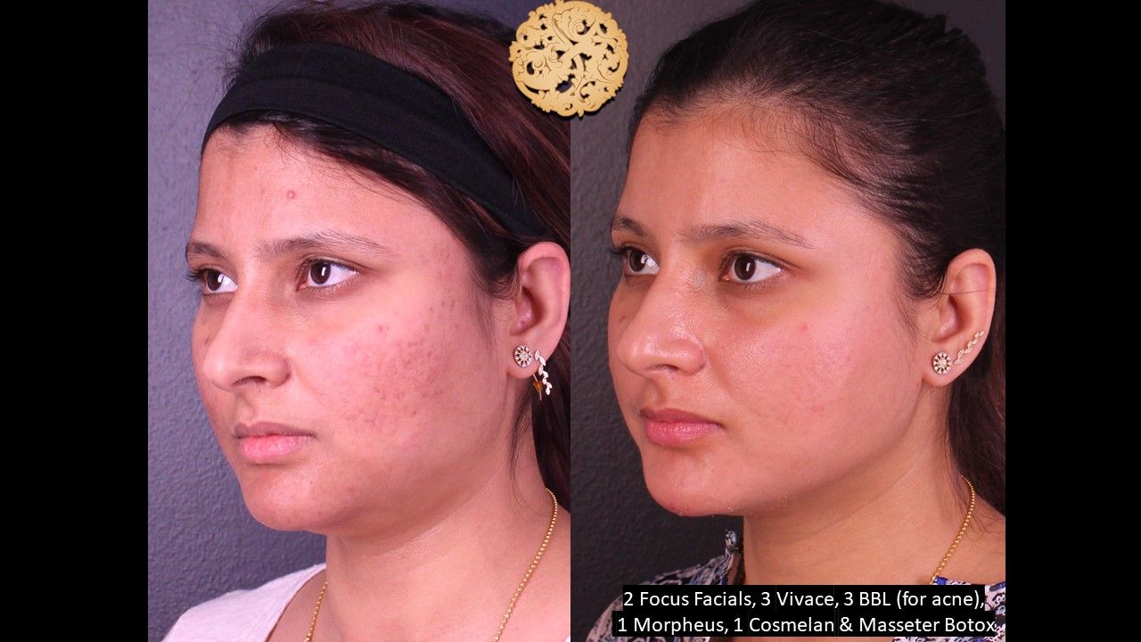 Chemical Peel Before & After