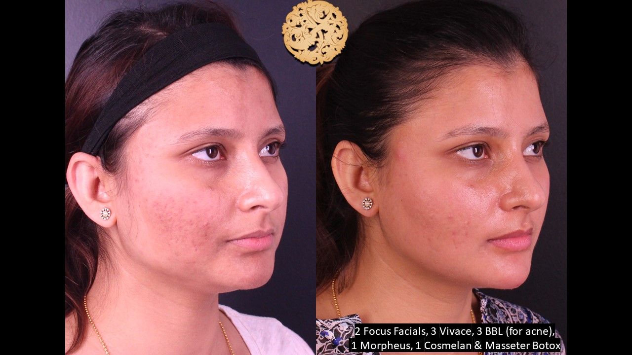 Chemical Peel Before & After