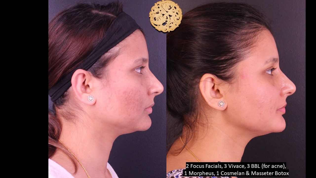 Chemical Peel Before & After