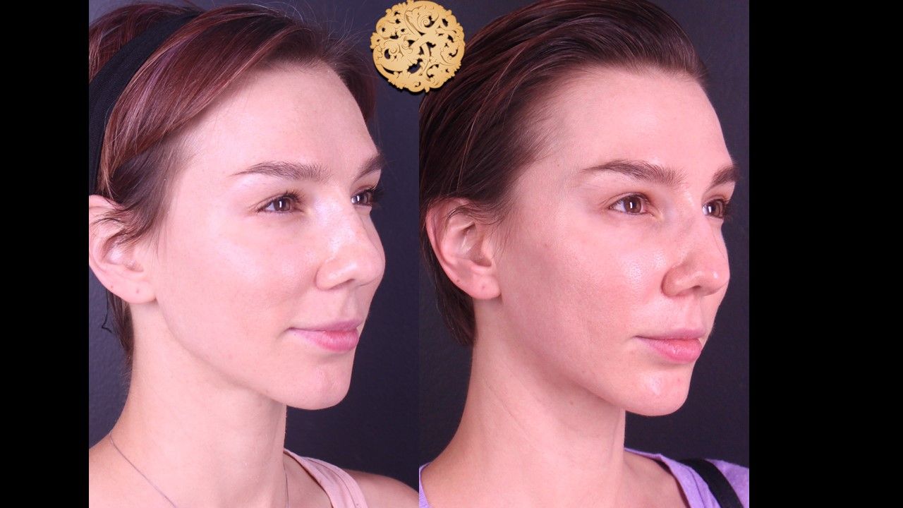 Chemical Peel Before & After
