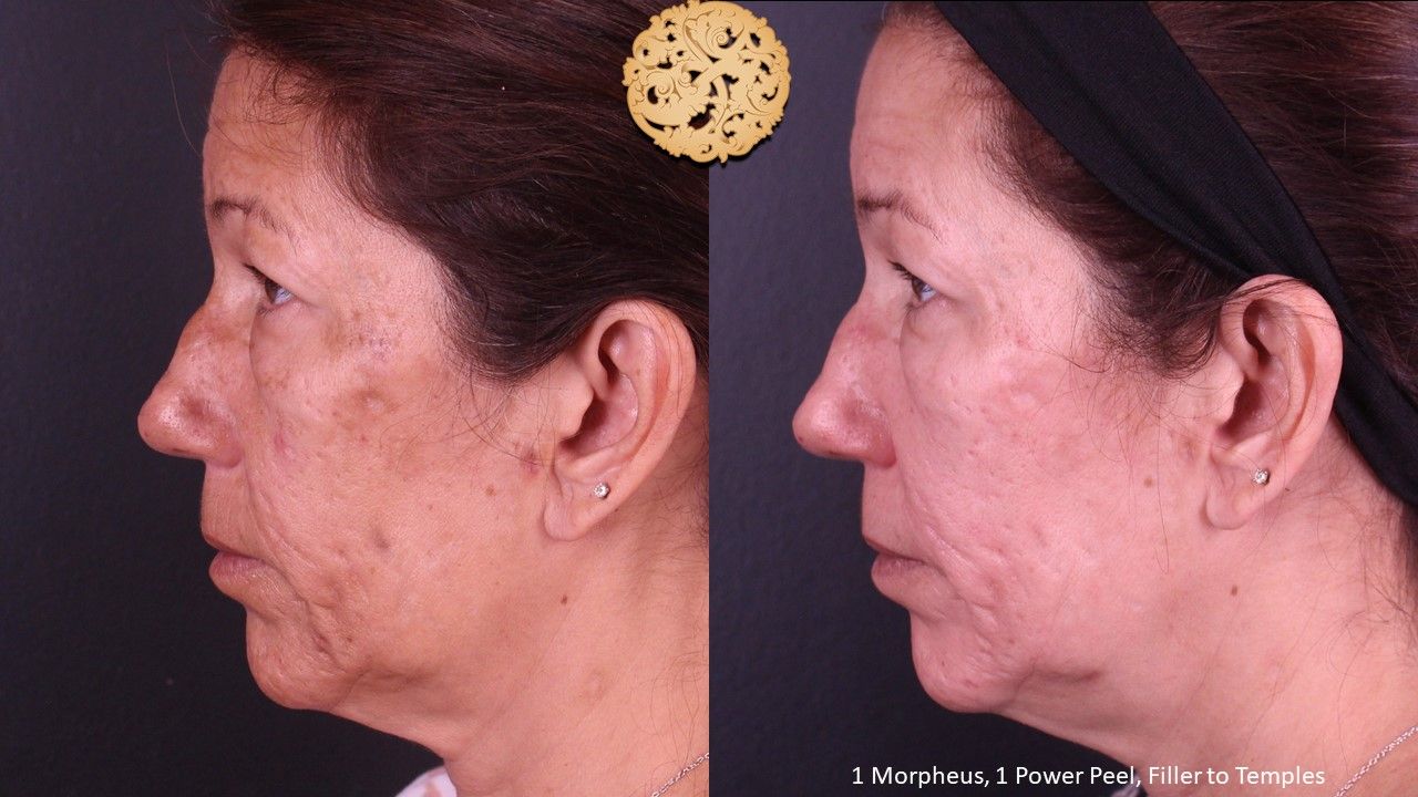 Chemical Peel Before & After