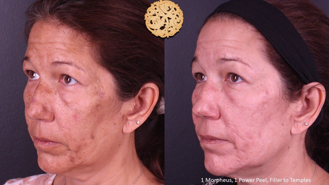 Chemical Peel Before & After