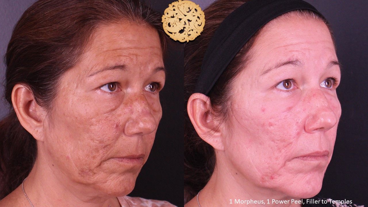 Chemical Peel Before & After