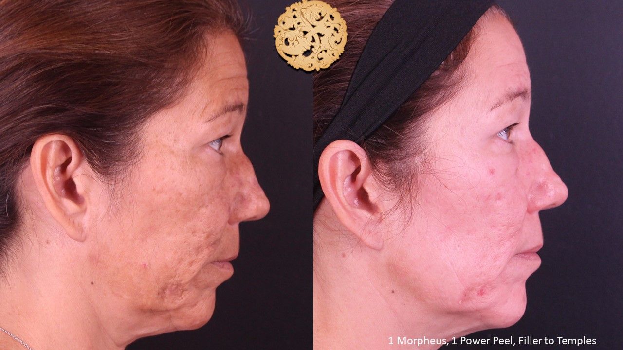 Chemical Peel Before & After
