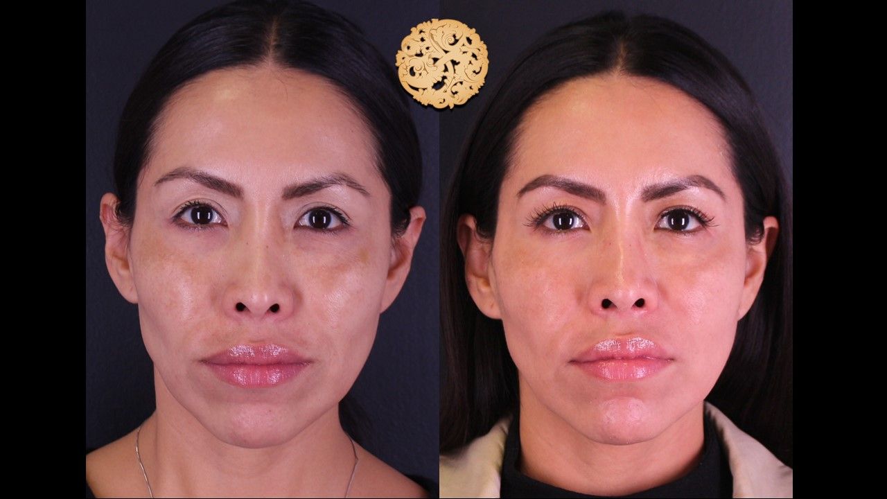 Chemical Peel Before & After