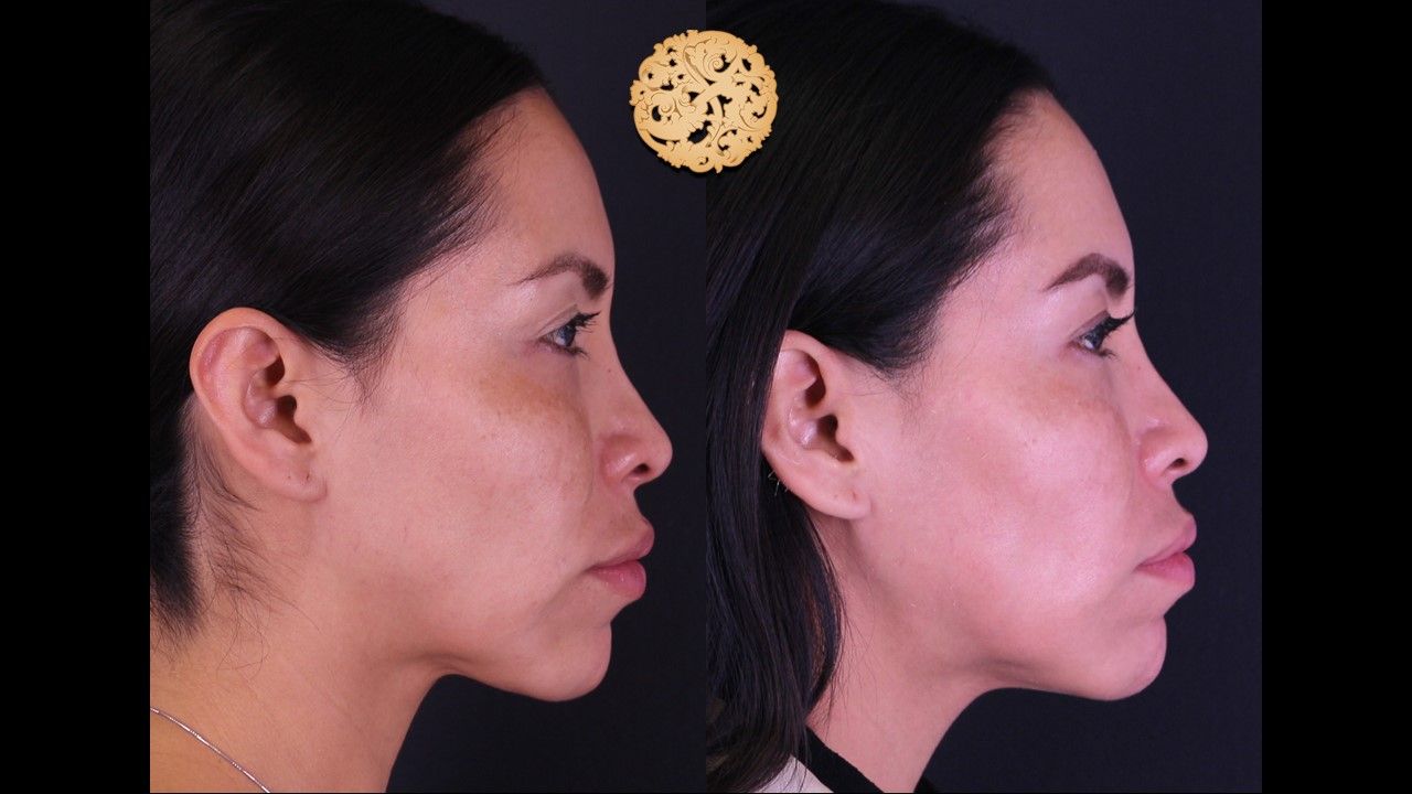 Chemical Peel Before & After