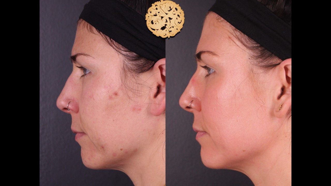 Chemical Peel Before & After