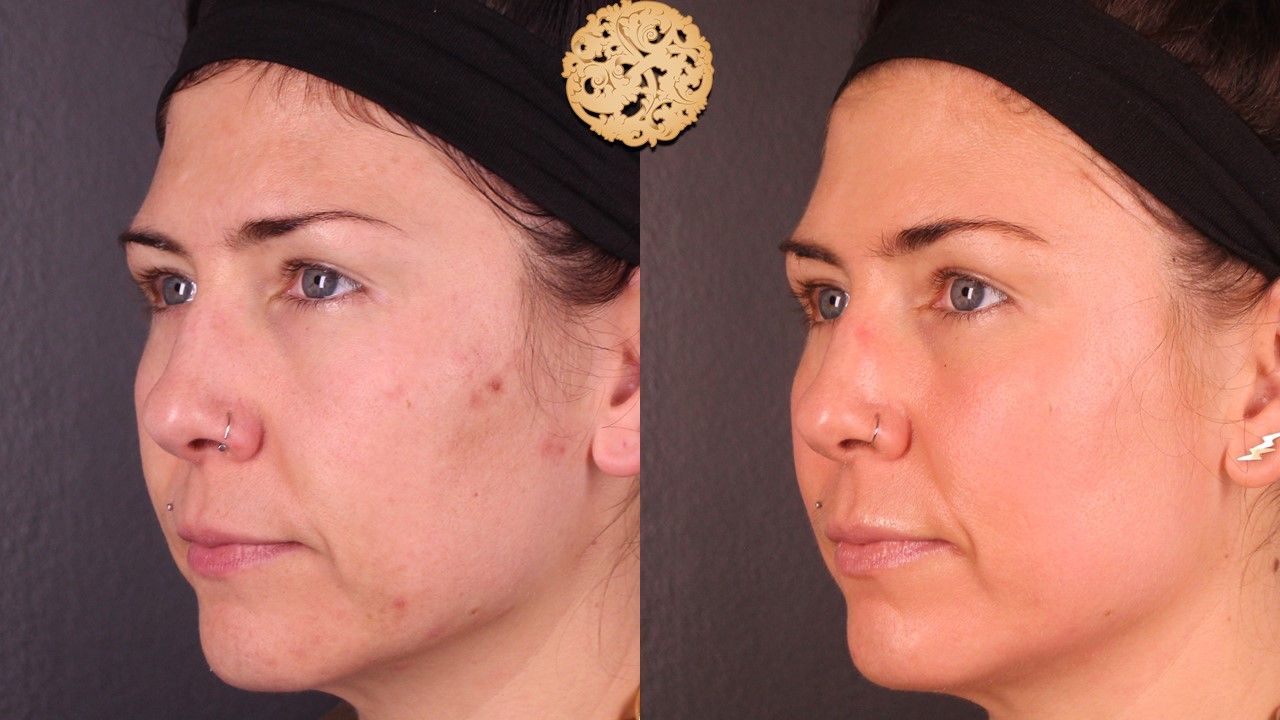 Chemical Peel Before & After