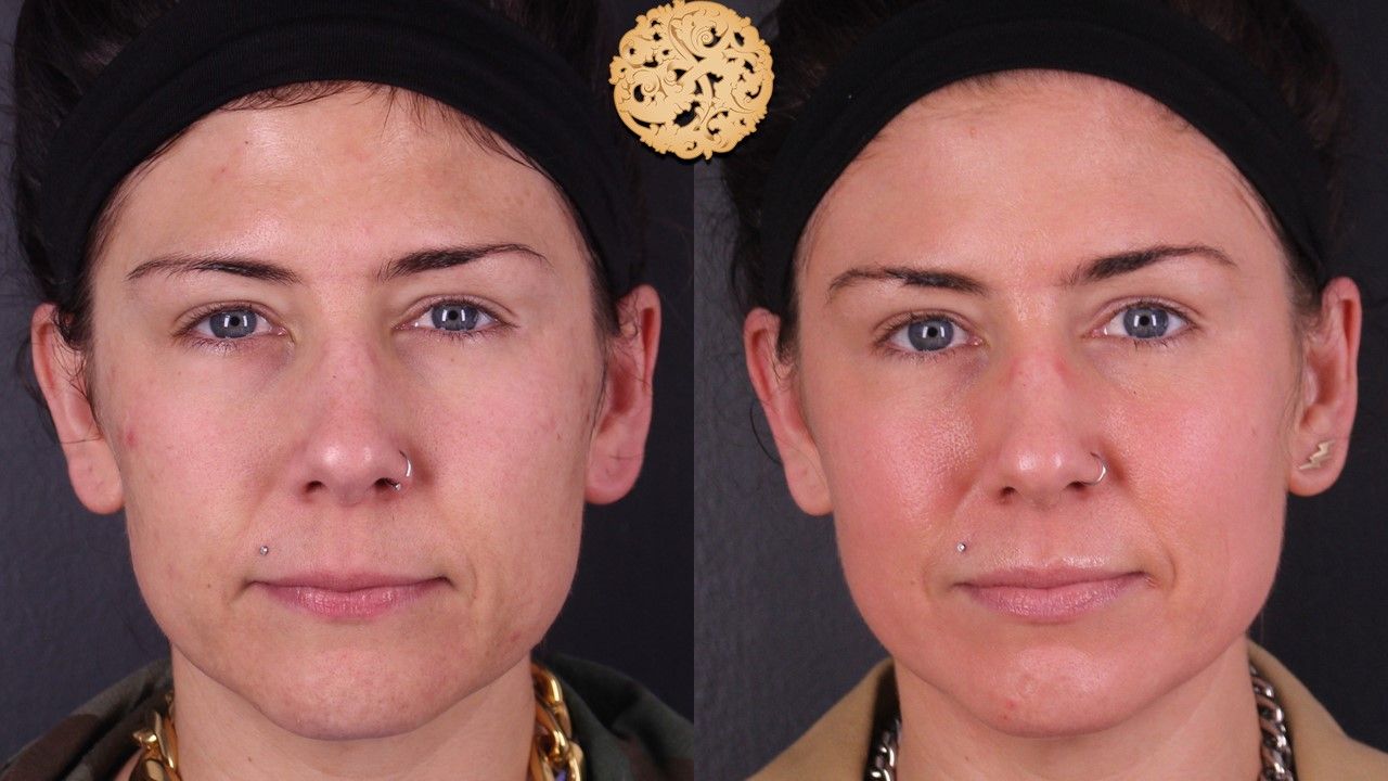 Chemical Peel Before & After