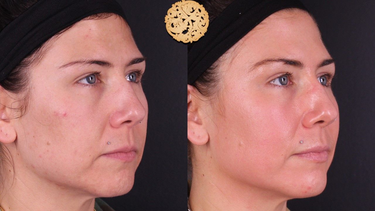 Chemical Peel Before & After