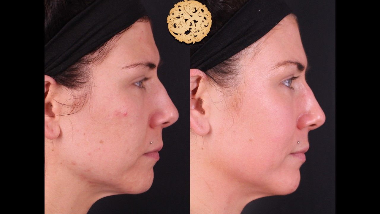 Chemical Peel Before & After