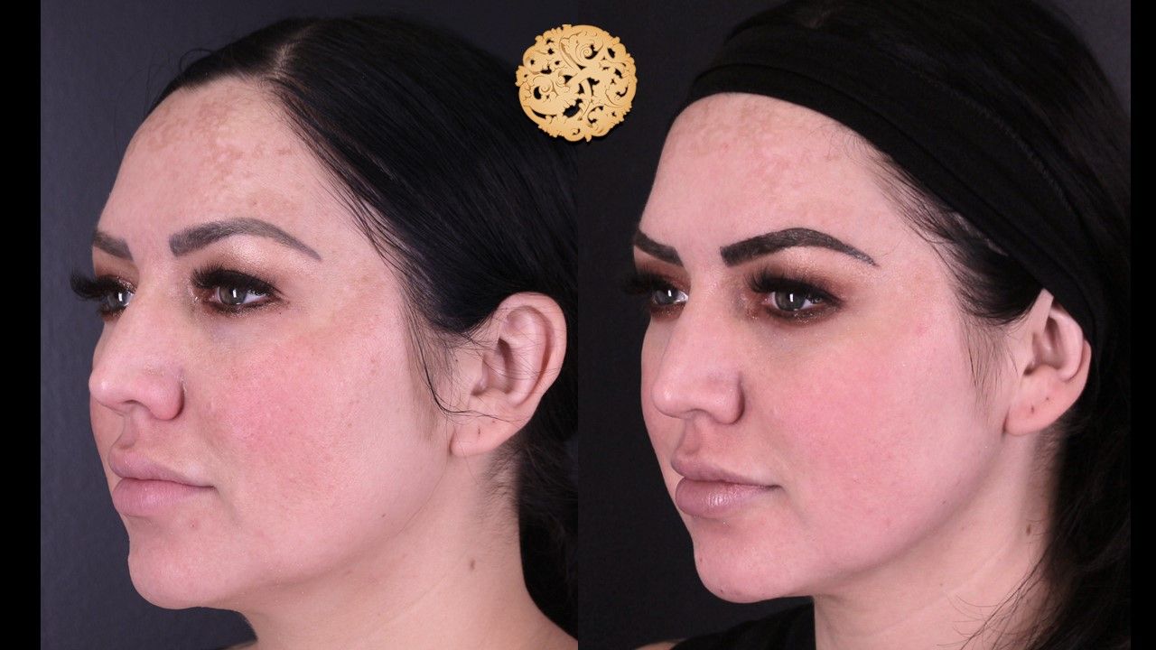 Chemical Peel Before & After