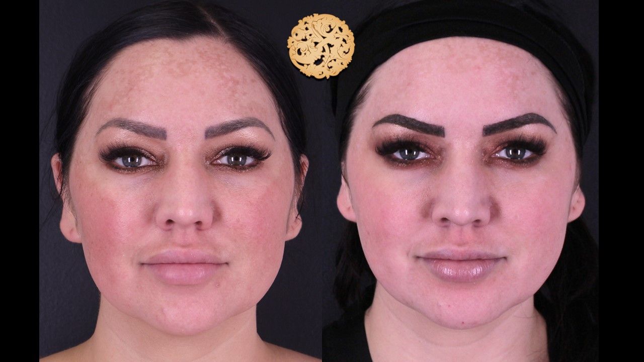 Chemical Peel Before & After