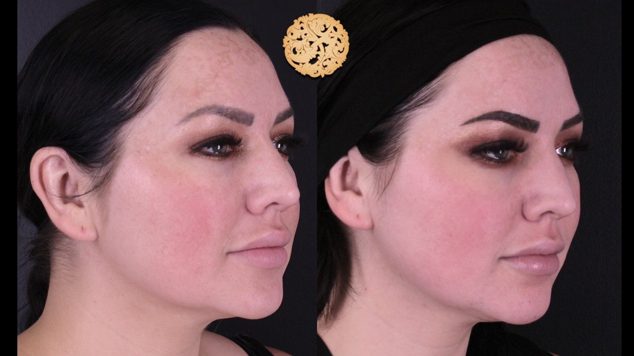 Chemical Peel Before & After