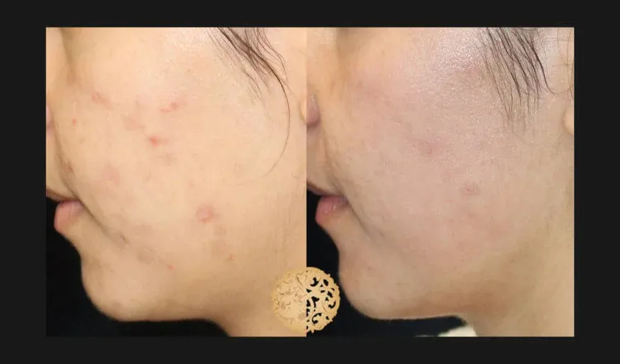 Chemical Peel Before & After