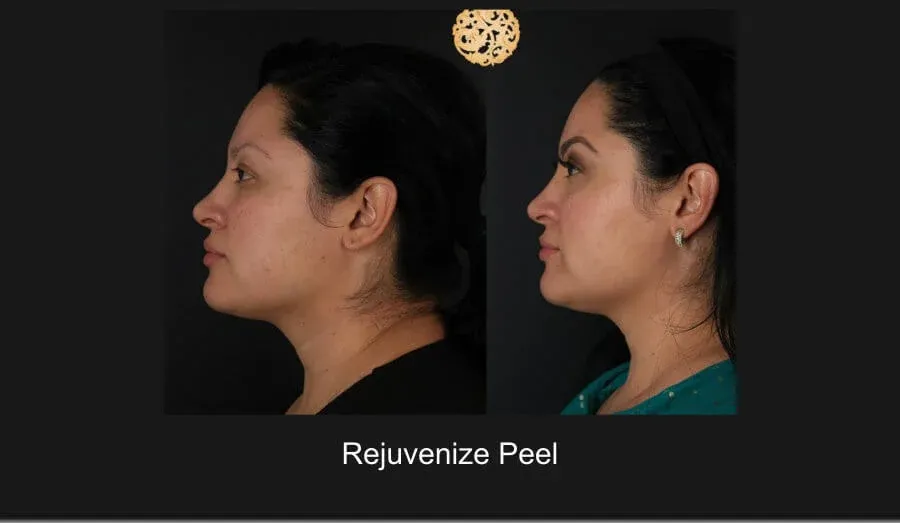 Chemical Peel Before & After