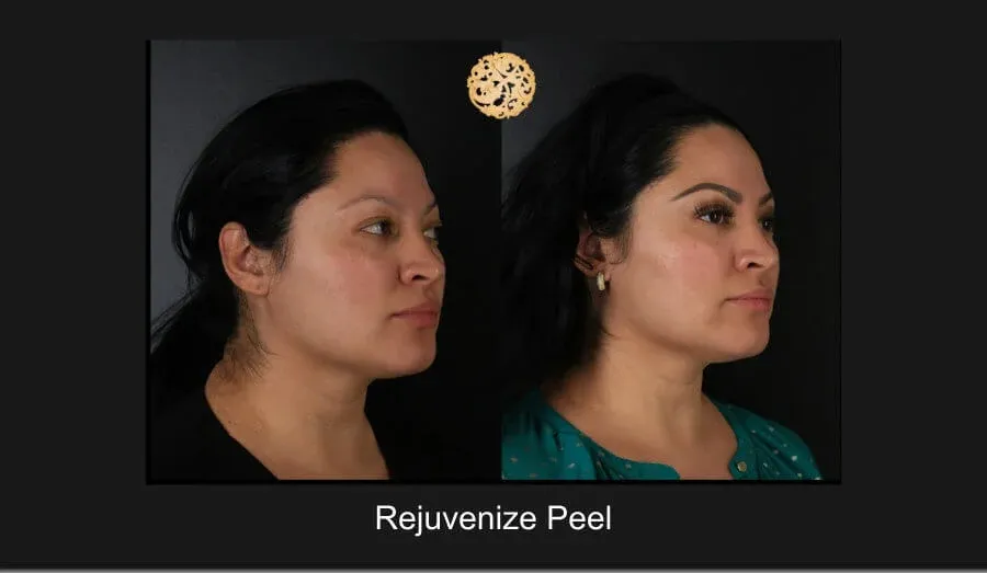 Chemical Peel Before & After