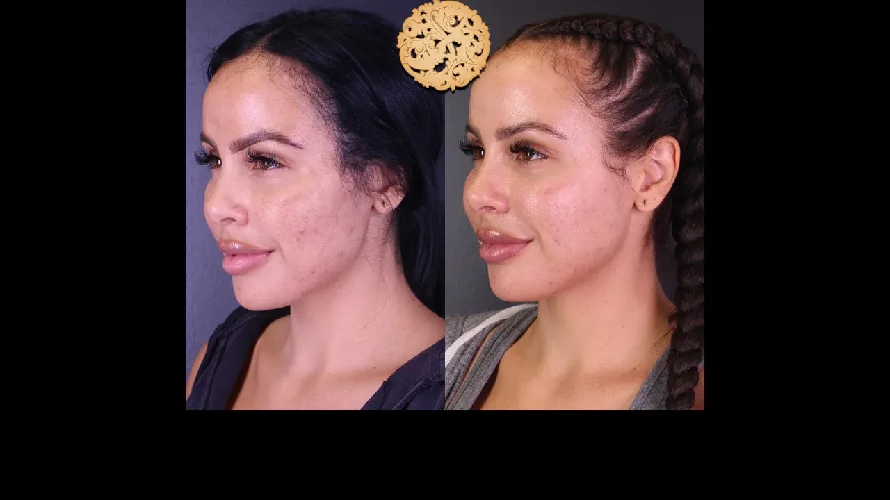 Chemical Peel Before & After
