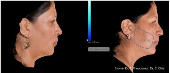 Evoke Before & After