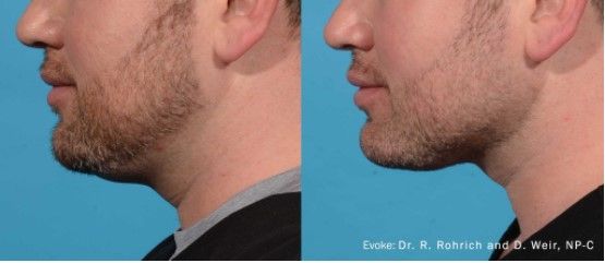 Evoke Before & After