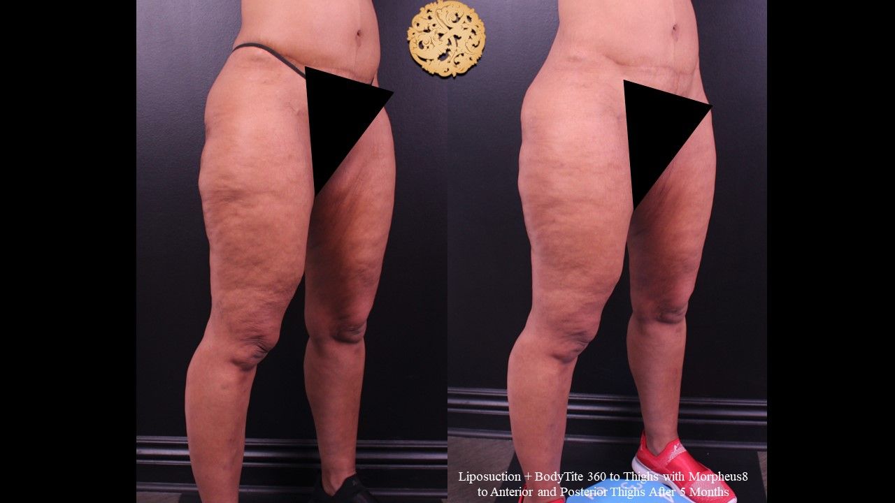 Morpheus Thighs Before & After
