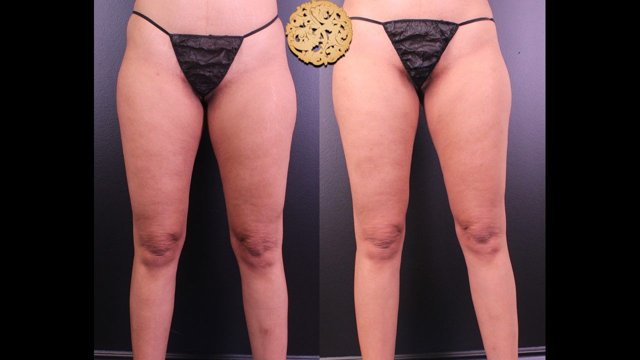 Morpheus Thighs Before & After
