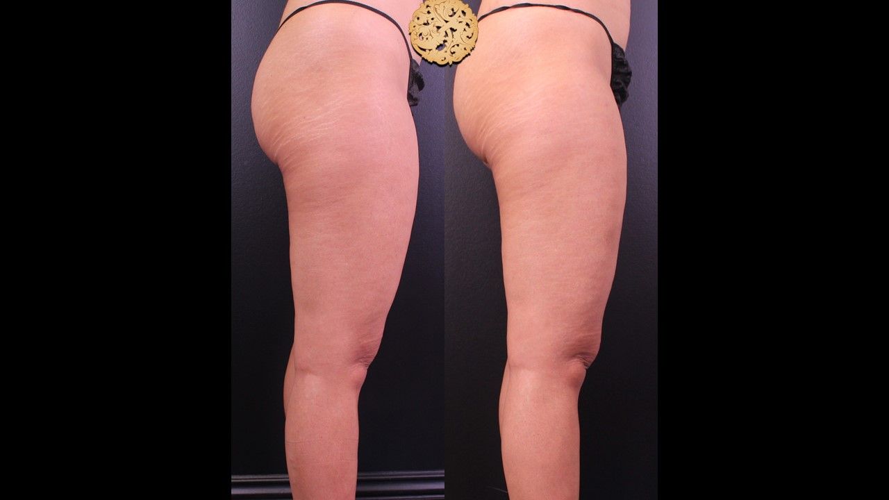 Morpheus Thighs Before & After