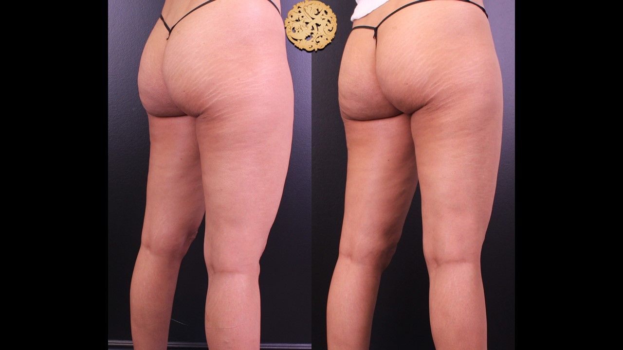 Morpheus Thighs Before & After