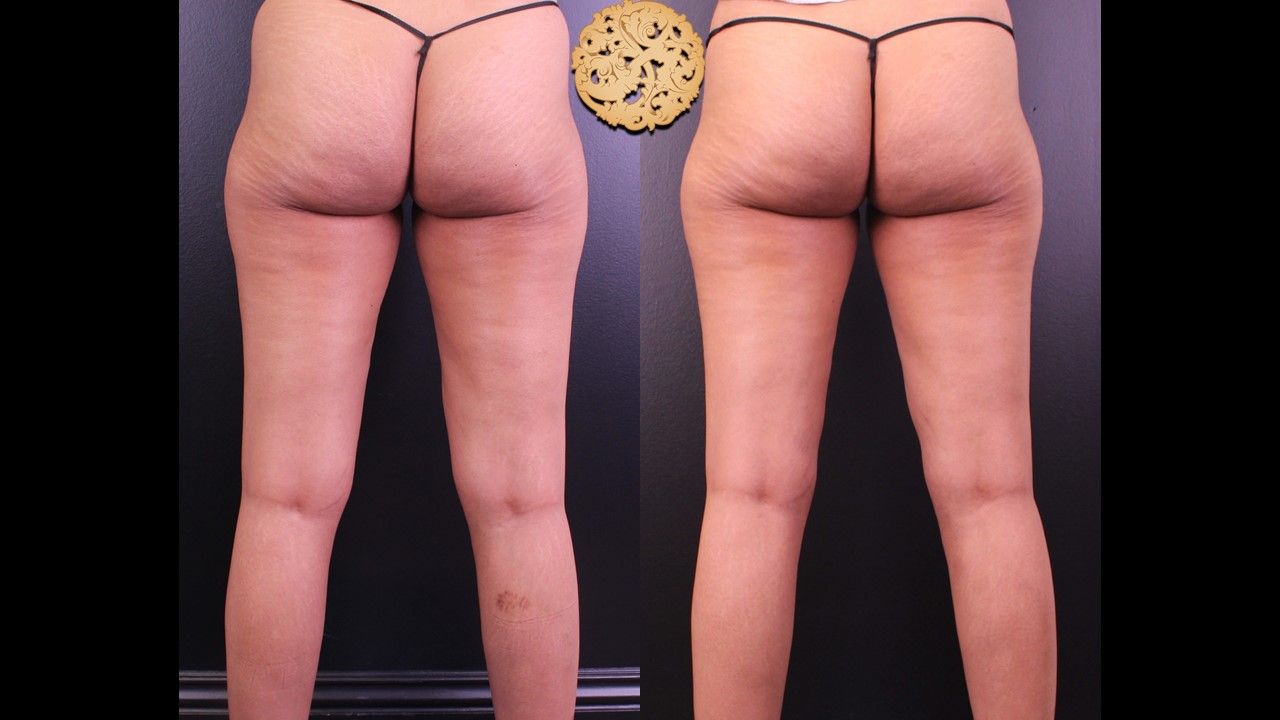 Morpheus Thighs Before & After
