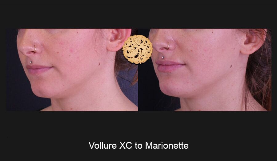 Marionette Filler Before & After