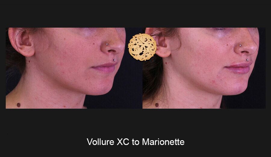 Marionette Filler Before & After