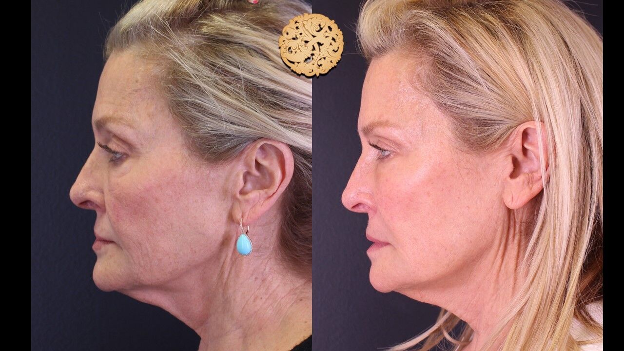 Marionette Filler Before & After