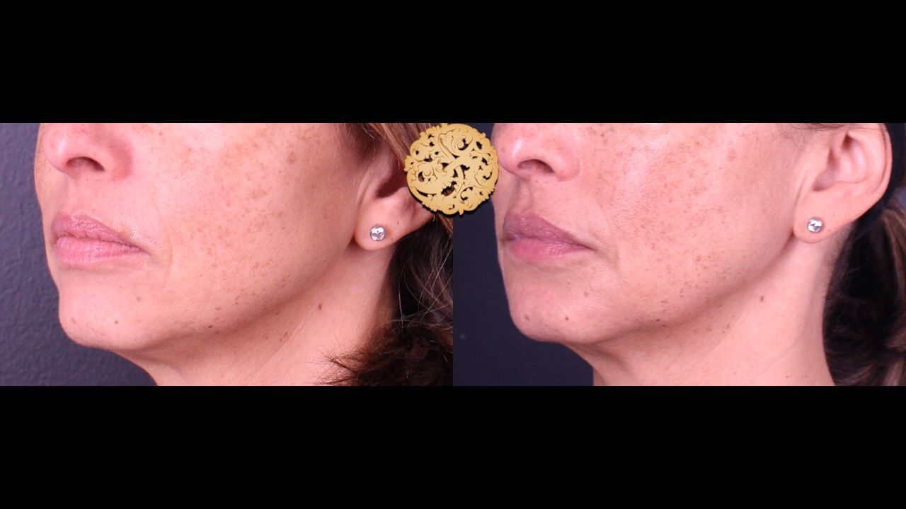 Marionette Filler Before & After
