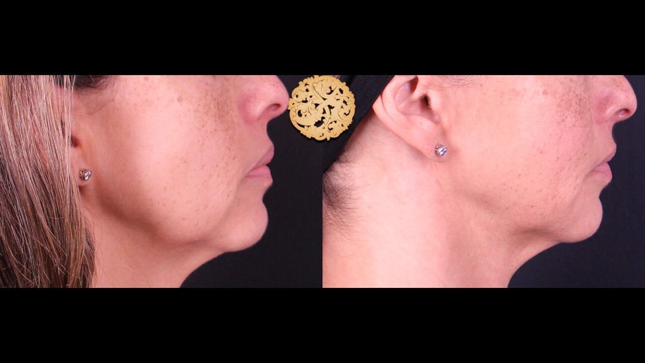 Marionette Filler Before & After