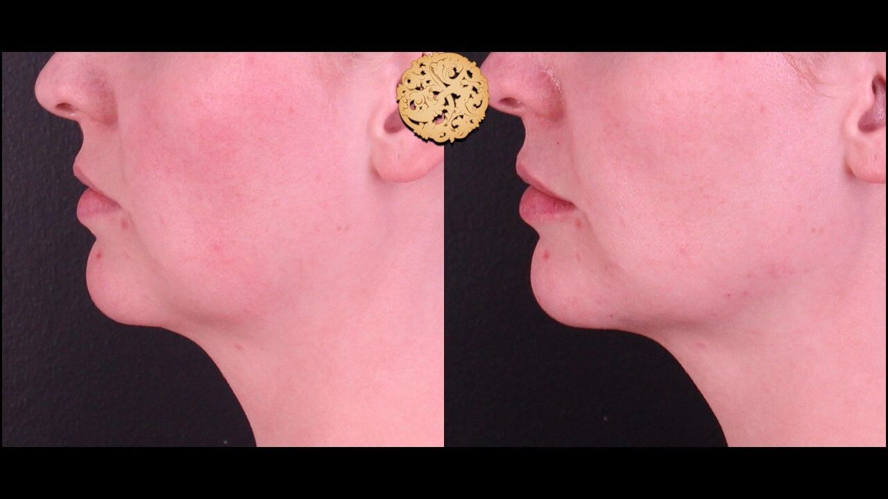 Marionette Filler Before & After