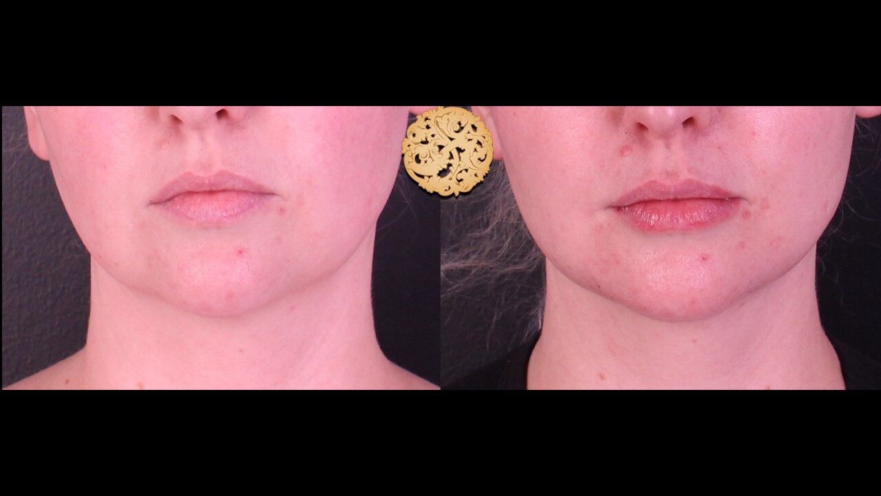 Marionette Filler Before & After