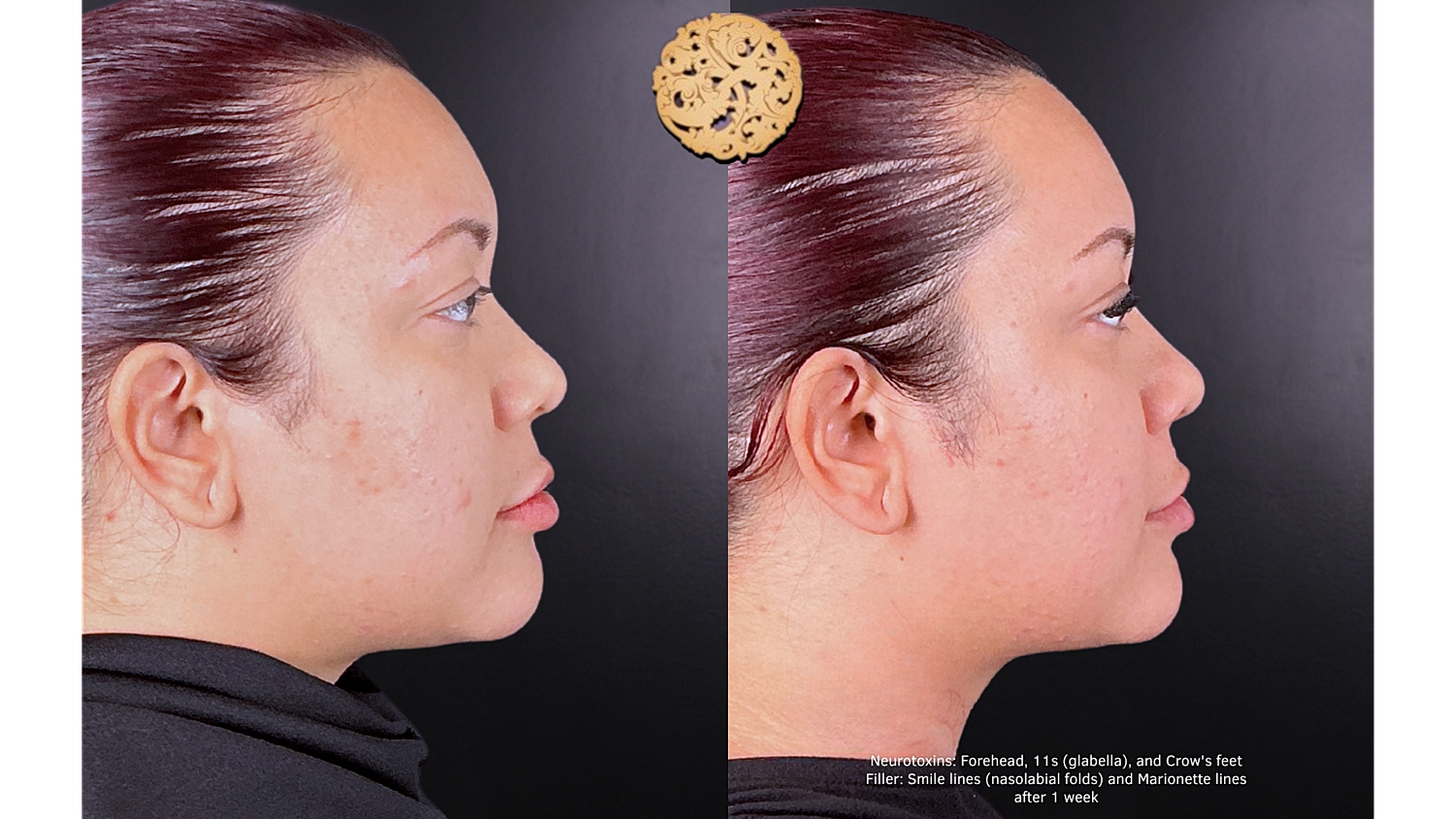 Marionette Filler Before & After