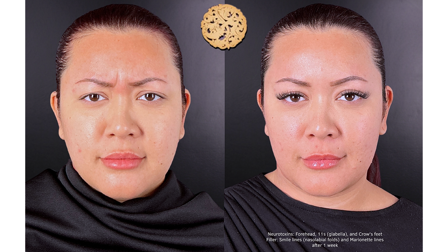 Marionette Filler Before & After
